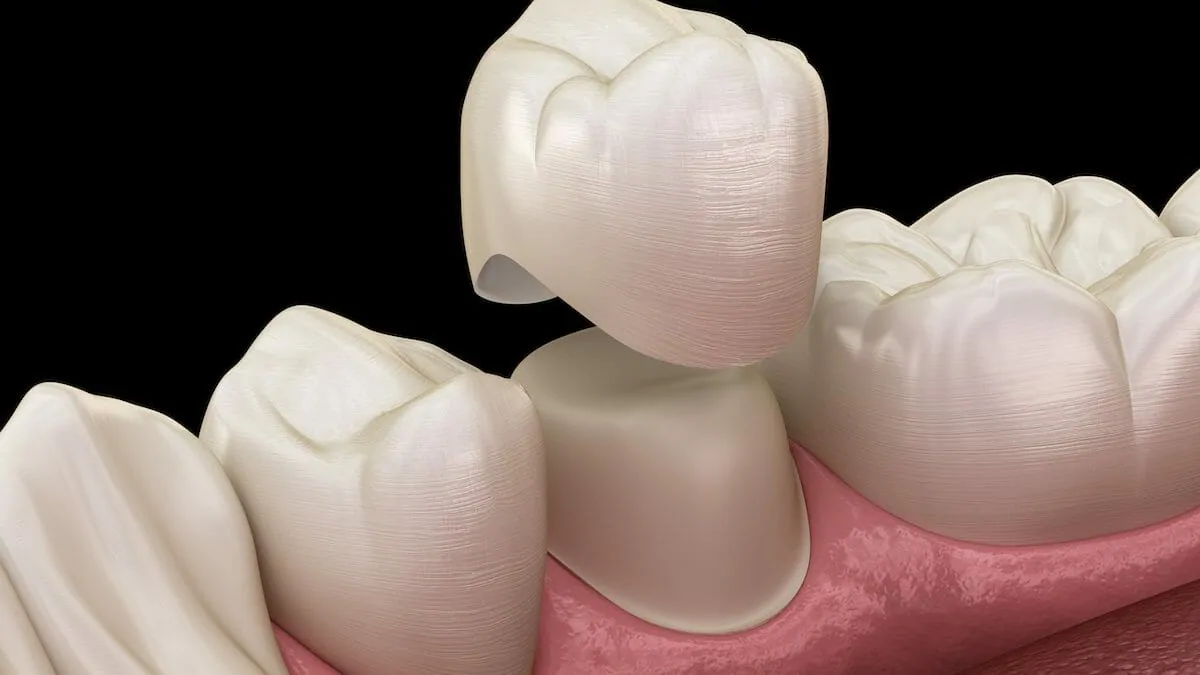 DENTAL CROWN IMPLANT